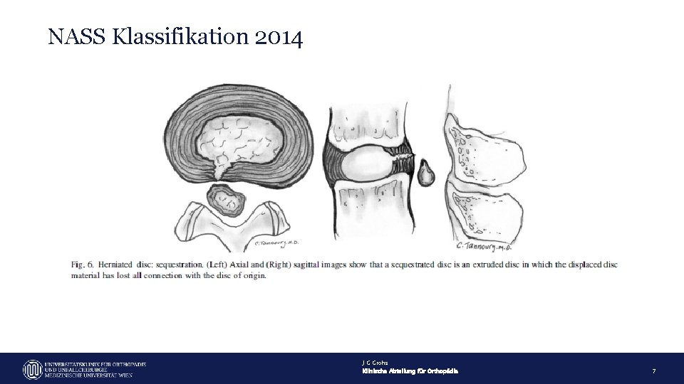 NASS Klassifikation 2014 J G Grohs Klinische Abteilung für Orthopädie 7 