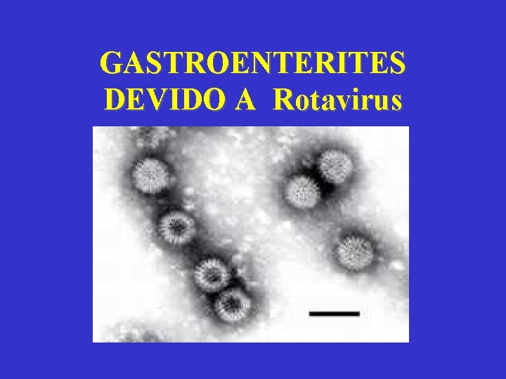 GASTROENTERITES DEVIDO A Rotavirus 