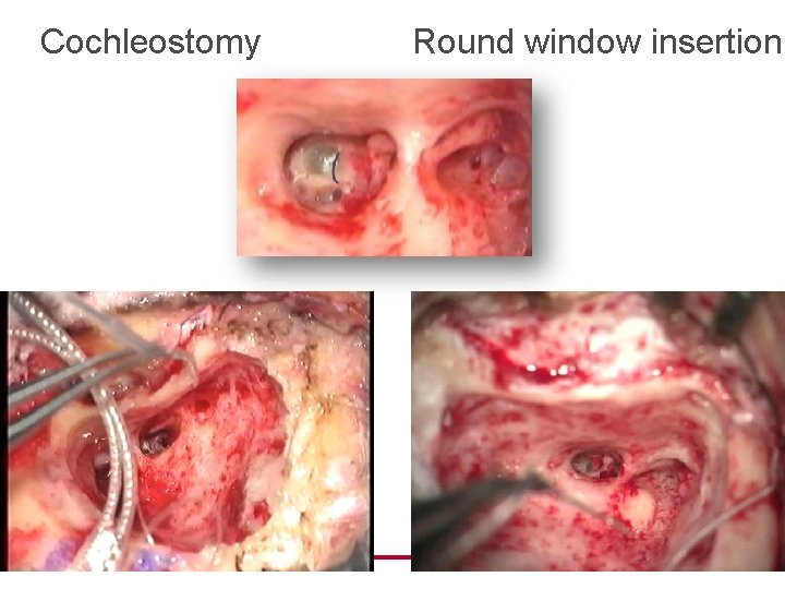 Cochleostomy Round window insertion 