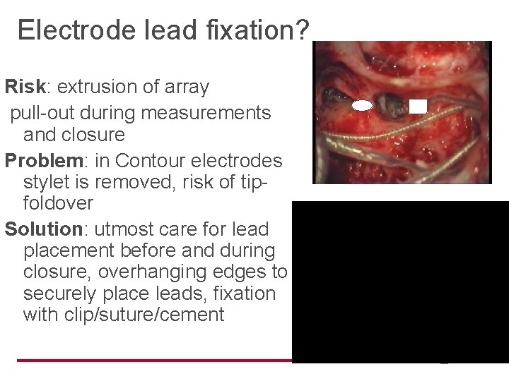 Electrode lead fixation? Risk: extrusion of array pull-out during measurements and closure Problem: in