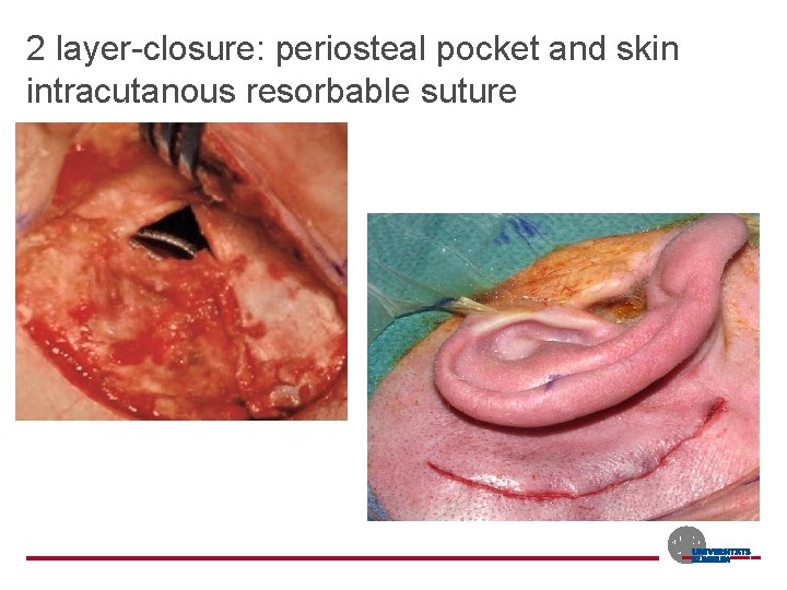 2 layer-closure: periosteal pocket and skin intracutanous resorbable suture 