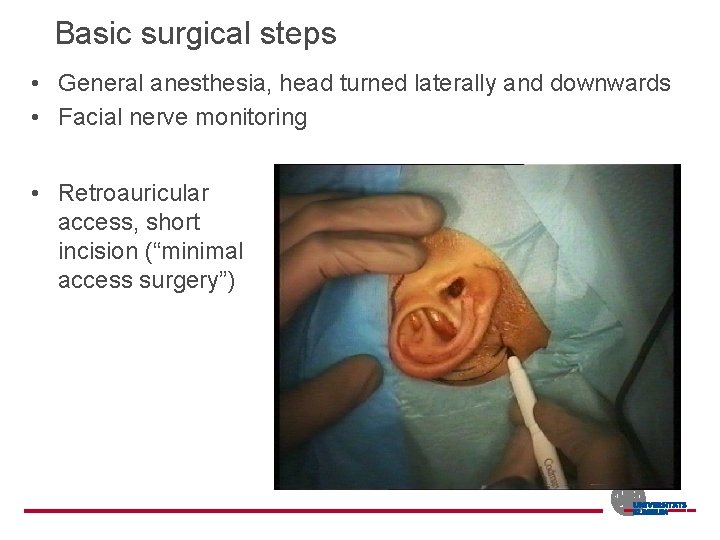Basic surgical steps • General anesthesia, head turned laterally and downwards • Facial nerve