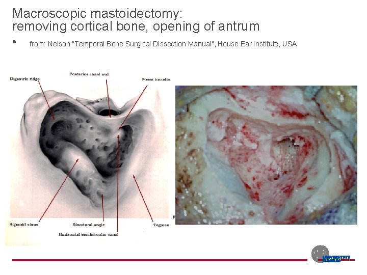 Macroscopic mastoidectomy: removing cortical bone, opening of antrum • from: Nelson "Temporal Bone Surgical