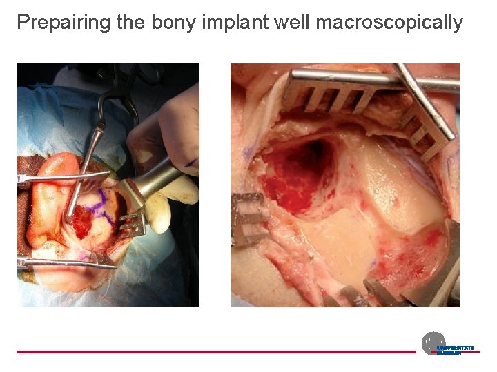 Prepairing the bony implant well macroscopically 