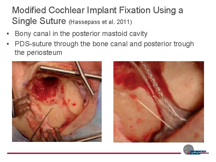 Modified Cochlear Implant Fixation Using a Single Suture (Hassepass et al. 2011) • Bony