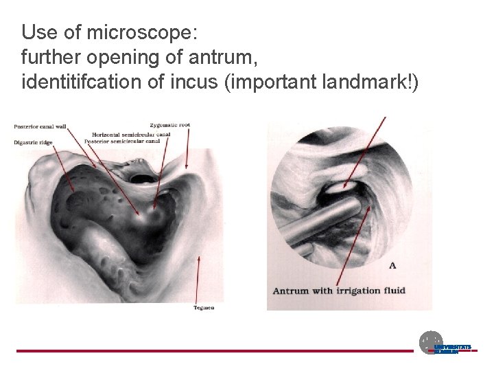 Use of microscope: further opening of antrum, identitifcation of incus (important landmark!) 