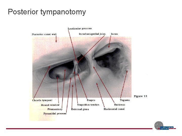 Posterior tympanotomy 