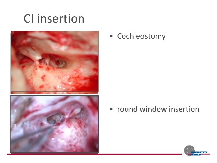 CI insertion • Cochleostomy • round window insertion 