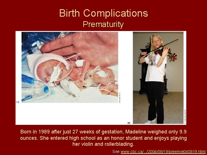 Birth Complications Prematurity Born in 1989 after just 27 weeks of gestation, Madeline weighed