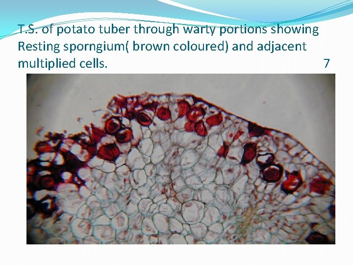 T. S. of potato tuber through warty portions showing Resting sporngium( brown coloured) and