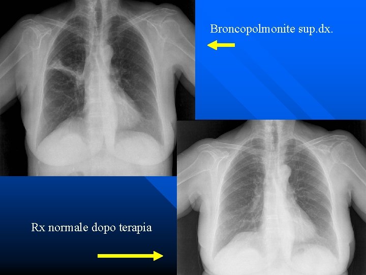 Broncopolmonite sup. dx. Rx normale dopo terapia 