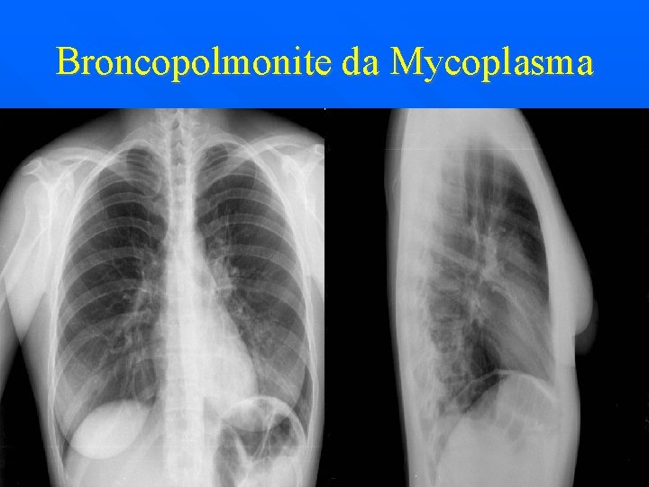 Broncopolmonite da Mycoplasma 