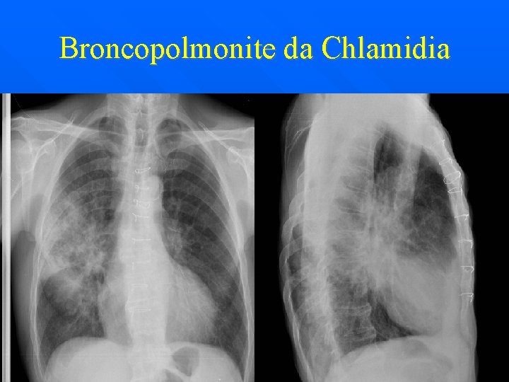 Broncopolmonite da Chlamidia 