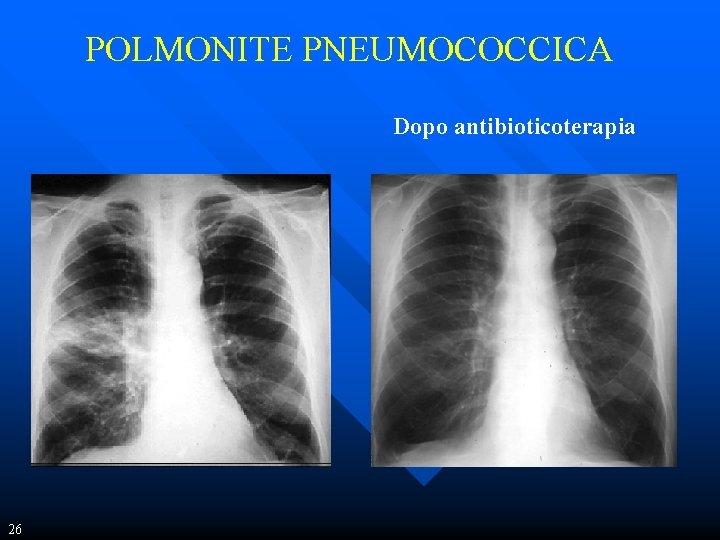 POLMONITE PNEUMOCOCCICA Dopo antibioticoterapia 26 