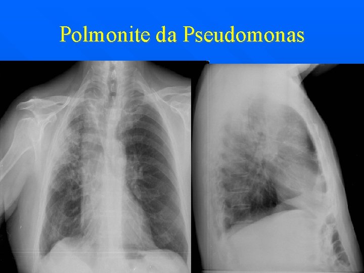 Polmonite da Pseudomonas 