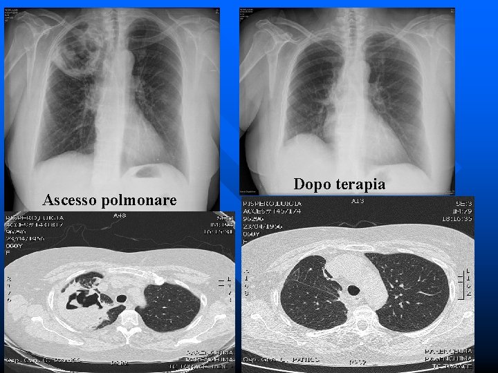 Ascesso polmonare Dopo terapia 