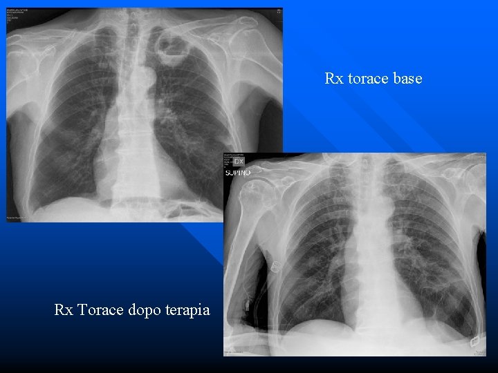 Rx torace base Rx Torace dopo terapia 