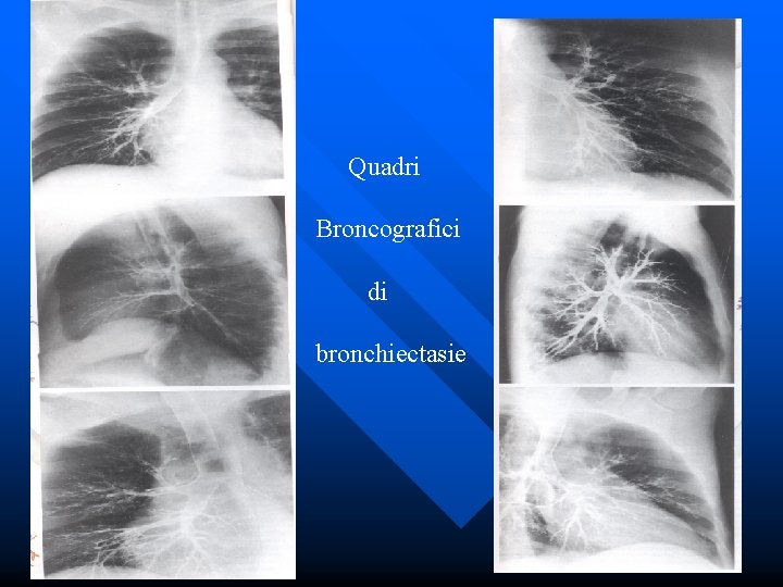 Quadri Broncografici di bronchiectasie 