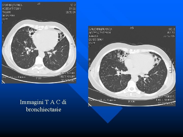 Immagini T A C di bronchiectasie 