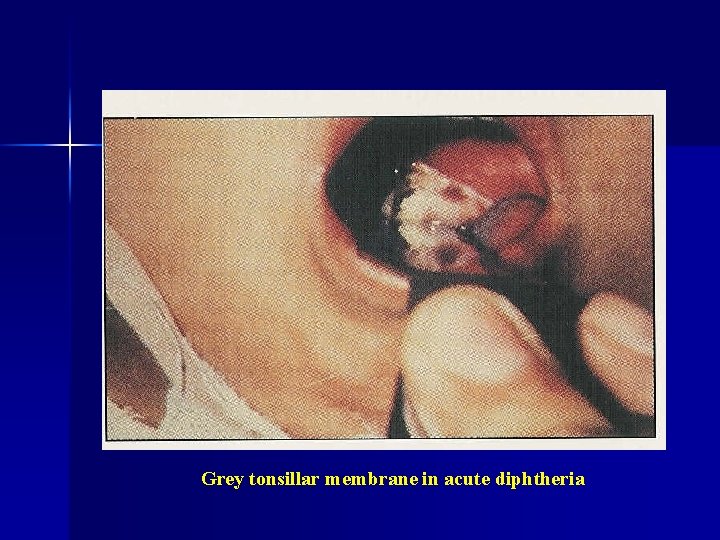 Grey tonsillar membrane in acute diphtheria 