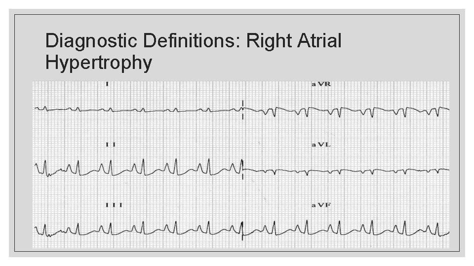 Diagnostic Definitions: Right Atrial Hypertrophy 