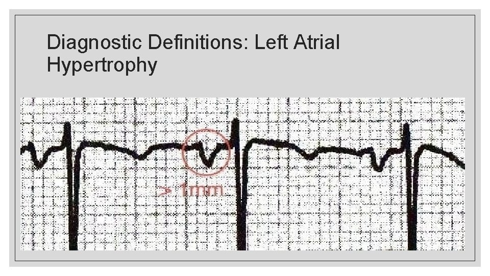 Diagnostic Definitions: Left Atrial Hypertrophy 