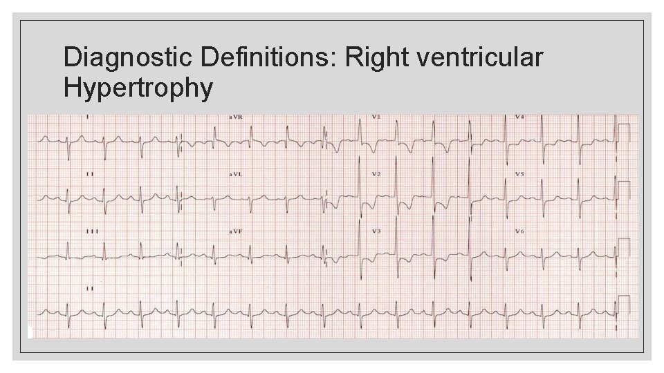 Diagnostic Definitions: Right ventricular Hypertrophy 