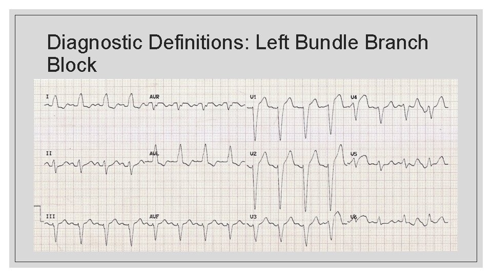 Diagnostic Definitions: Left Bundle Branch Block 