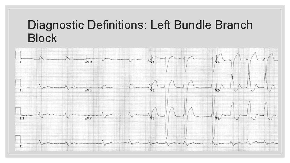 Diagnostic Definitions: Left Bundle Branch Block 