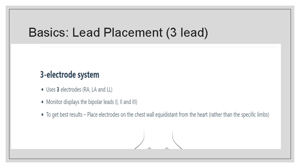 Basics: Lead Placement (3 lead) 