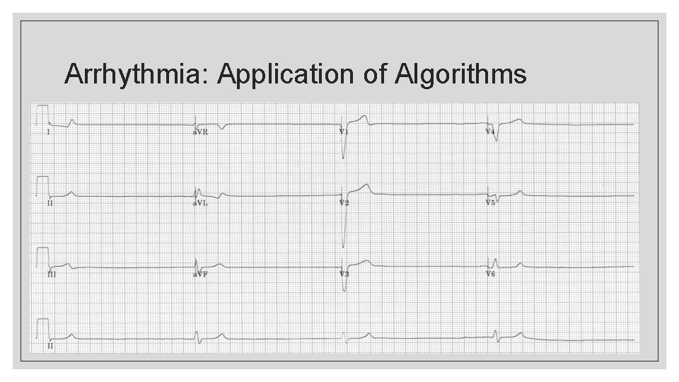 Arrhythmia: Application of Algorithms 