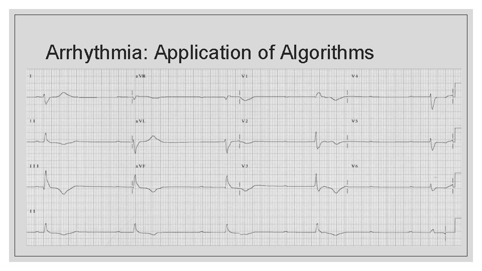 Arrhythmia: Application of Algorithms 