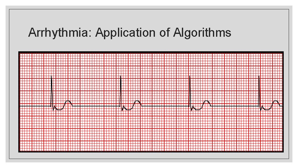 Arrhythmia: Application of Algorithms 