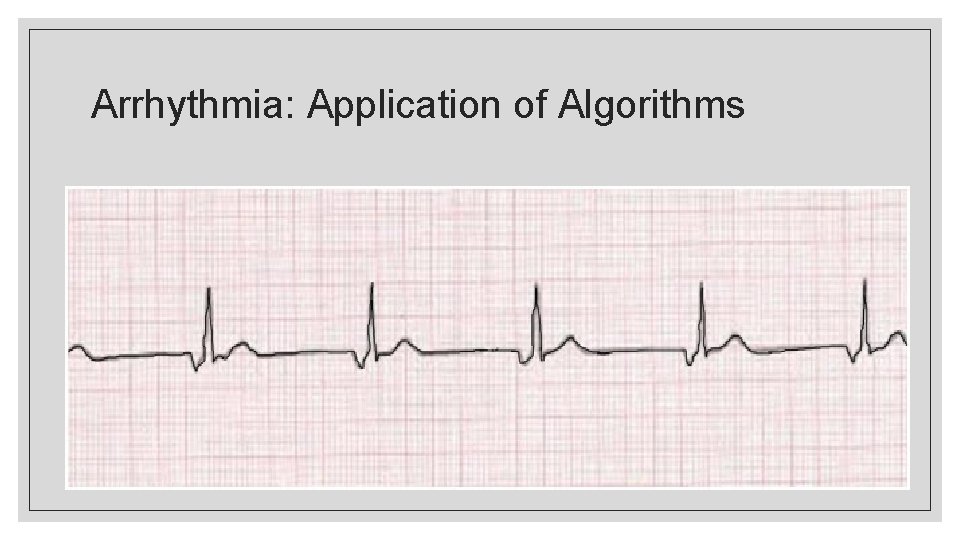 Arrhythmia: Application of Algorithms 