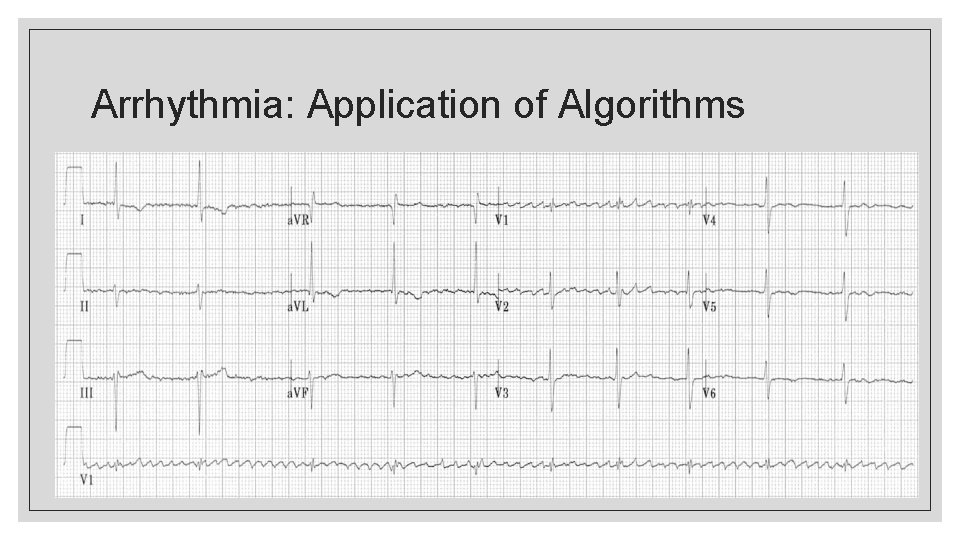 Arrhythmia: Application of Algorithms 