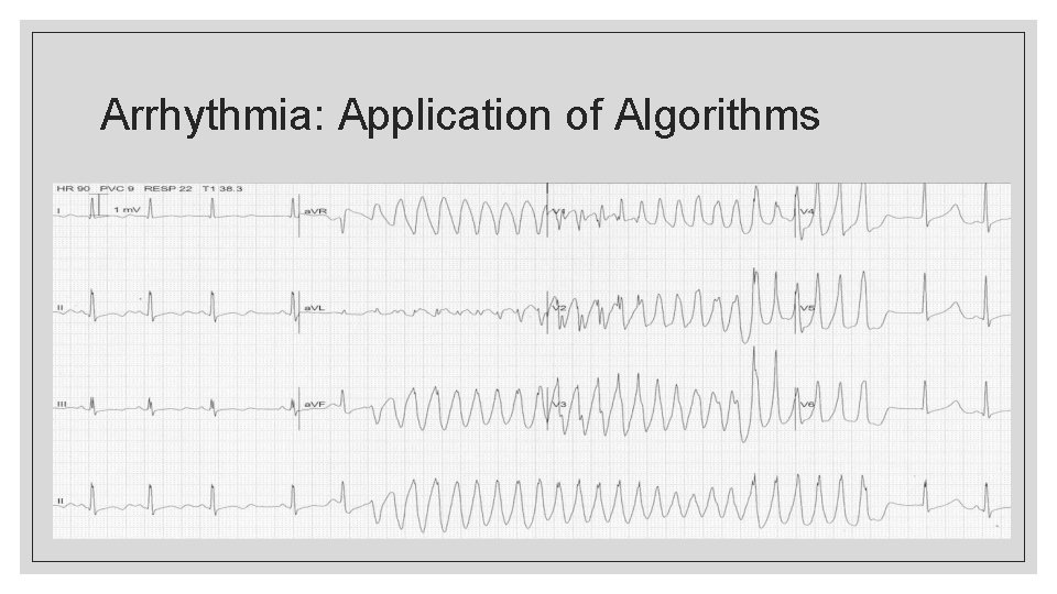 Arrhythmia: Application of Algorithms 