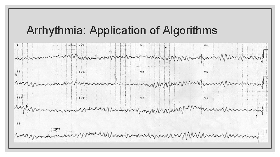 Arrhythmia: Application of Algorithms 