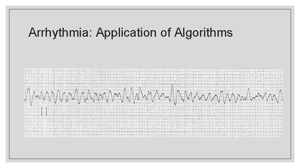 Arrhythmia: Application of Algorithms 