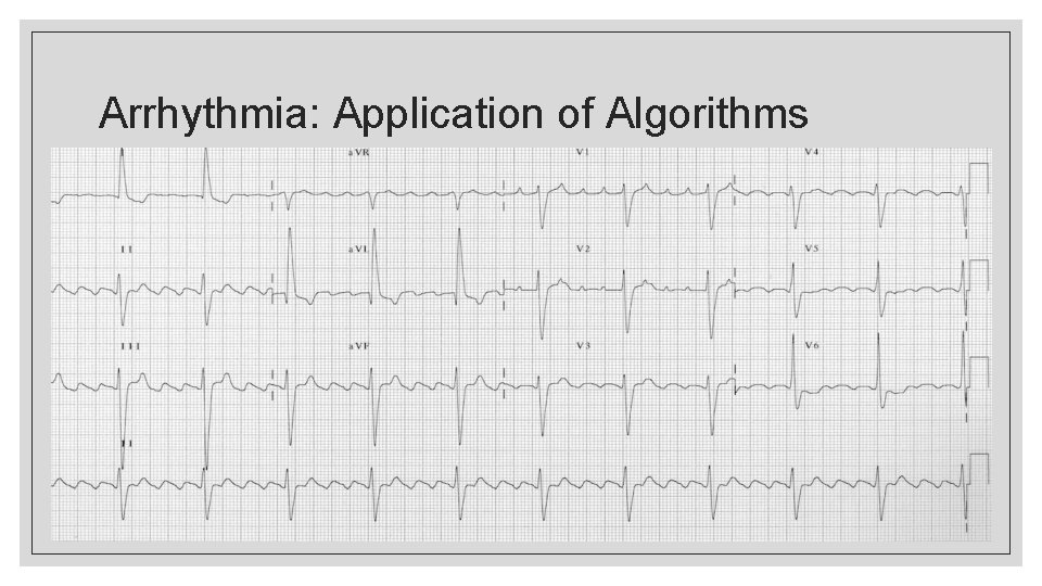 Arrhythmia: Application of Algorithms 