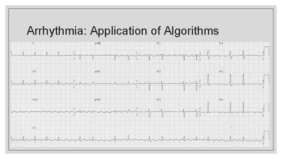 Arrhythmia: Application of Algorithms 