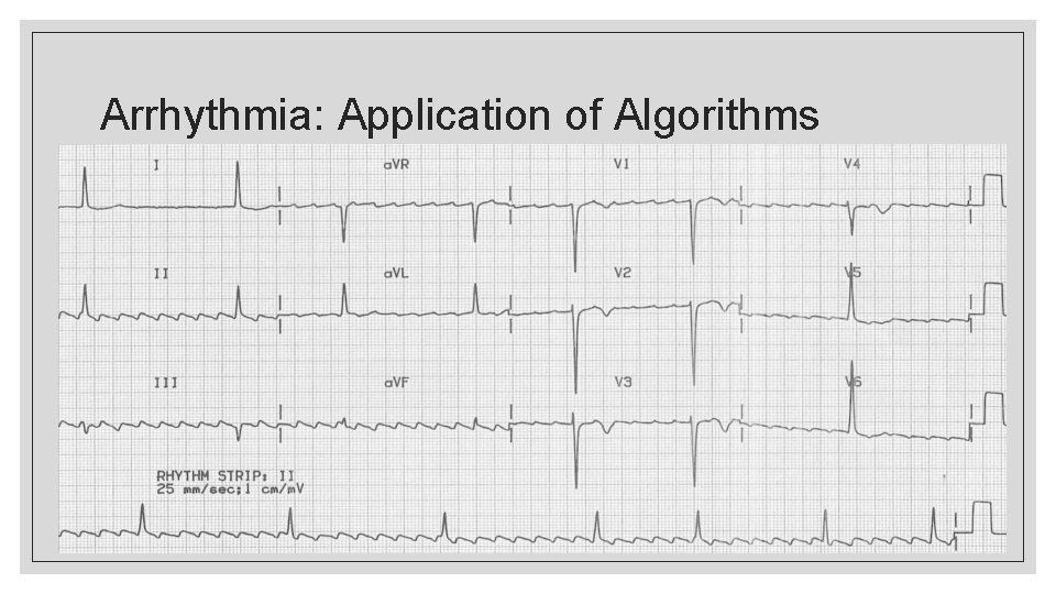 Arrhythmia: Application of Algorithms 