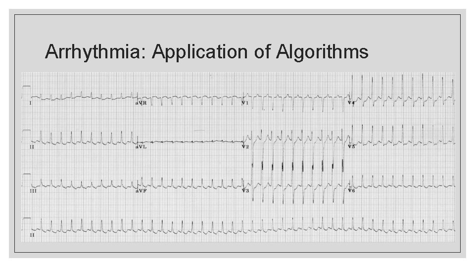 Arrhythmia: Application of Algorithms 