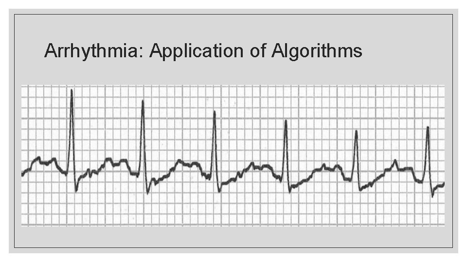 Arrhythmia: Application of Algorithms 