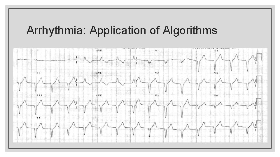 Arrhythmia: Application of Algorithms 