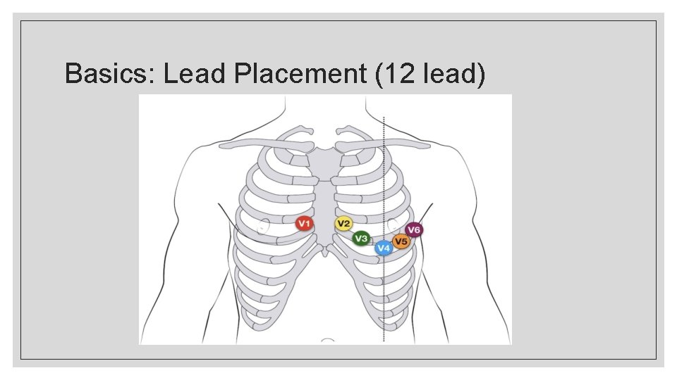 Basics: Lead Placement (12 lead) 