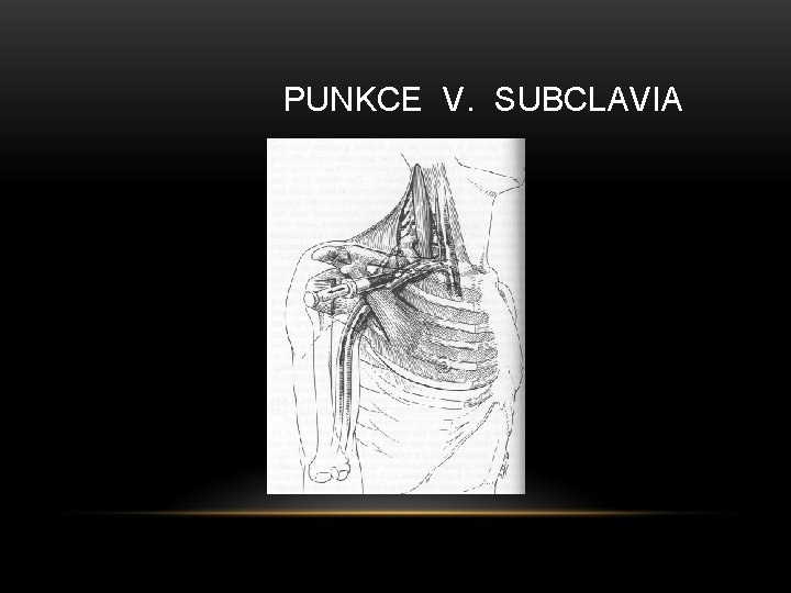 PUNKCE V. SUBCLAVIA 