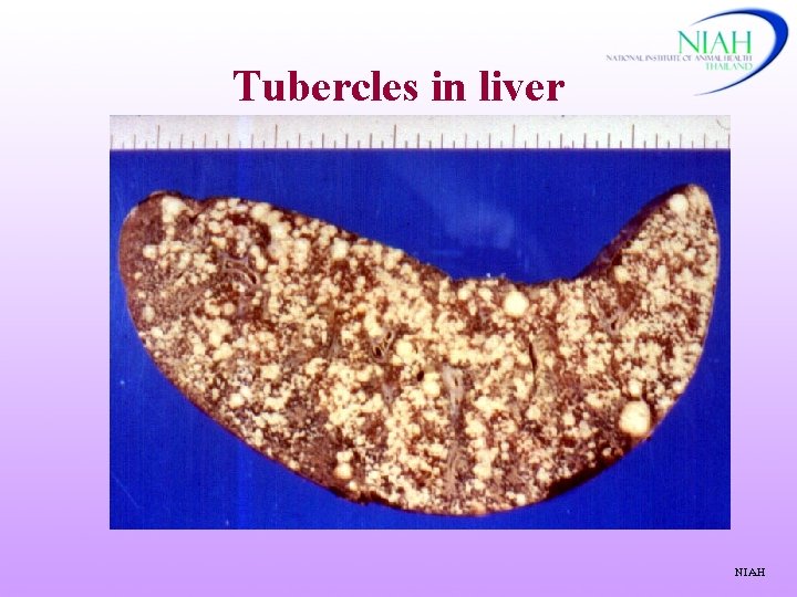 Tubercles in liver NIAH 