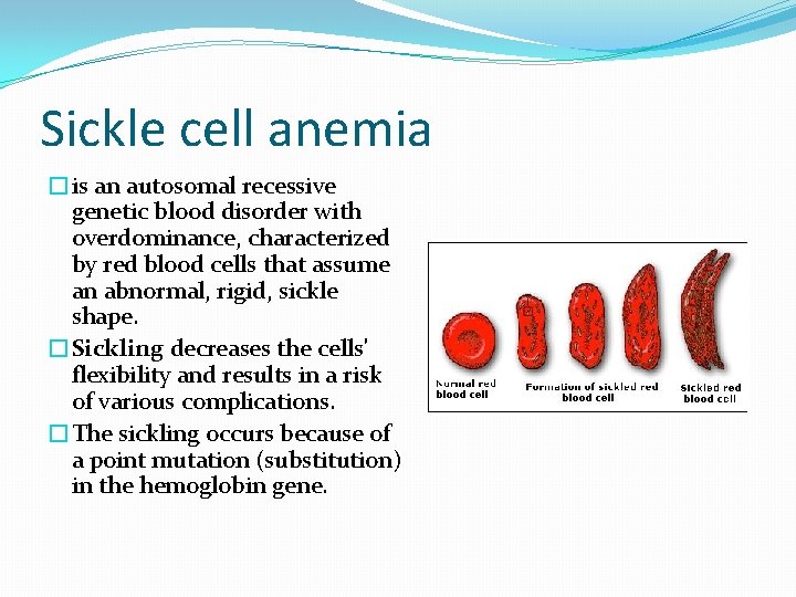Sickle cell anemia �is an autosomal recessive genetic blood disorder with overdominance, characterized by