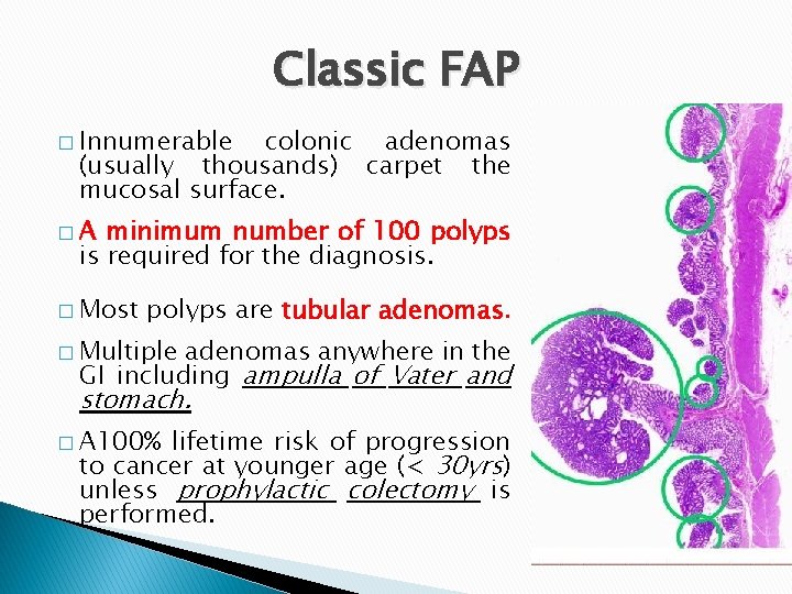 Classic FAP � Innumerable colonic adenomas (usually thousands) carpet the mucosal surface. �A minimum