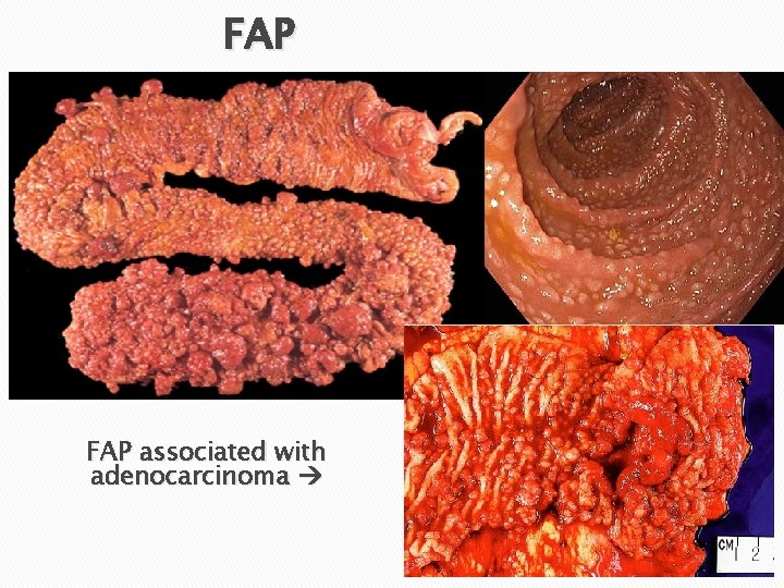 FAP associated with adenocarcinoma 